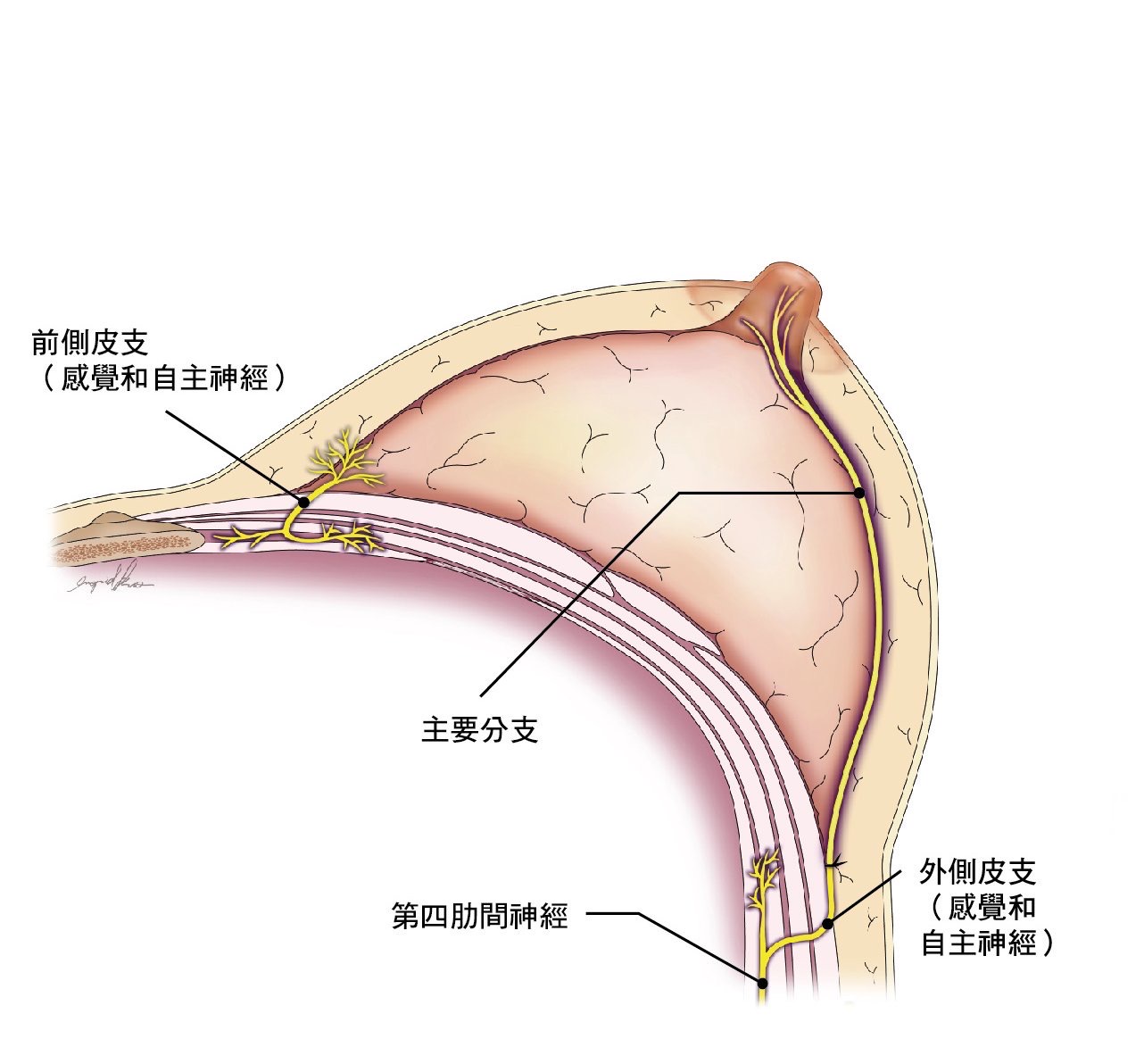   林口長庚乳房神經重建手術，使用肋間神經移植重建乳房感覺神經。圖/林口長庚醫院提供