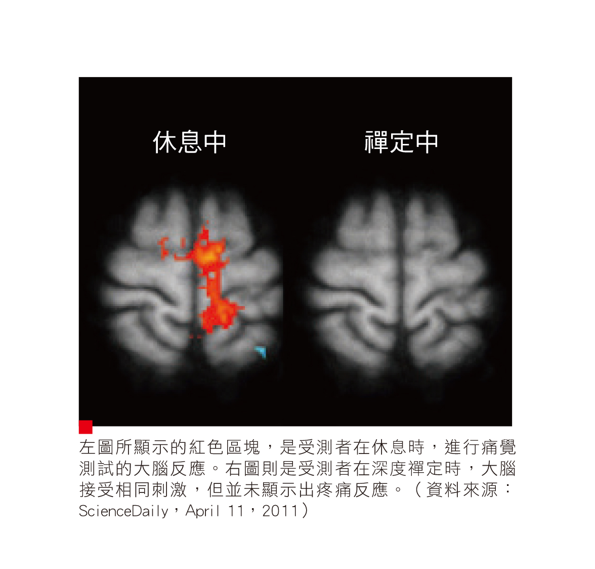 左圖所顯示的紅色區塊，是受測者在休息時，進行痛覺測試的大腦反應。右圖則是受測者在深度禪定時，大腦接受相同刺激，但並未顯示出疼痛反應。（資料來源：ScienceDaily，April 11，2011）