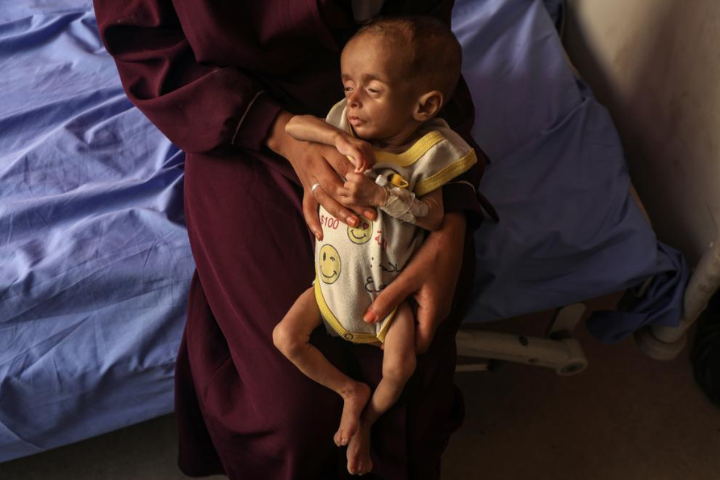 加薩衛生當局指出，隨著戰爭進入第二年、死亡人數逼近6萬，死於飢餓與營養不良的人數正在攀升。圖為23日加薩一所醫院裡拍到的營養不良兒童。圖/新華社