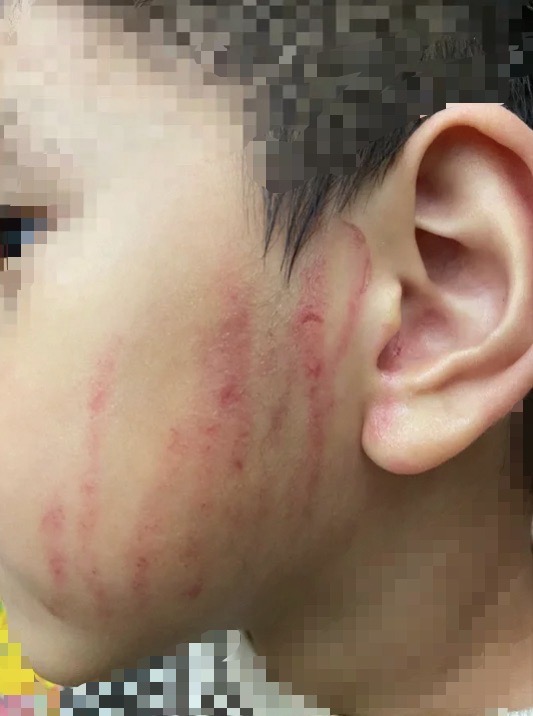 幼教老師為讓男童「體驗」痛感　出手抓傷他臉頰