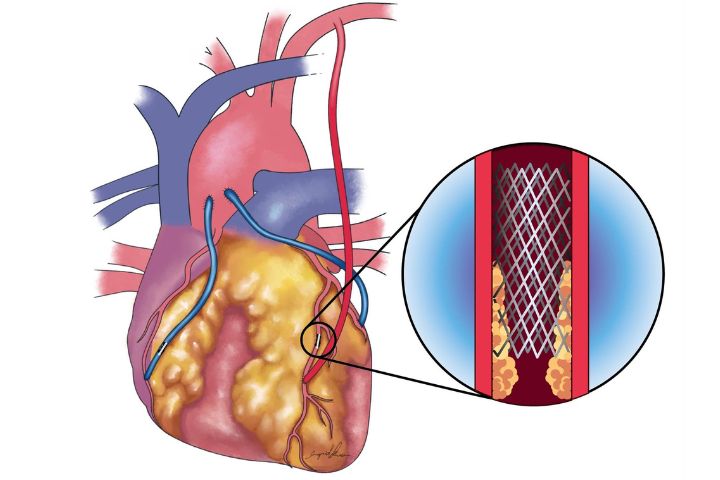 長庚示警：曾放心臟支架再做繞道手術　死亡風險升高