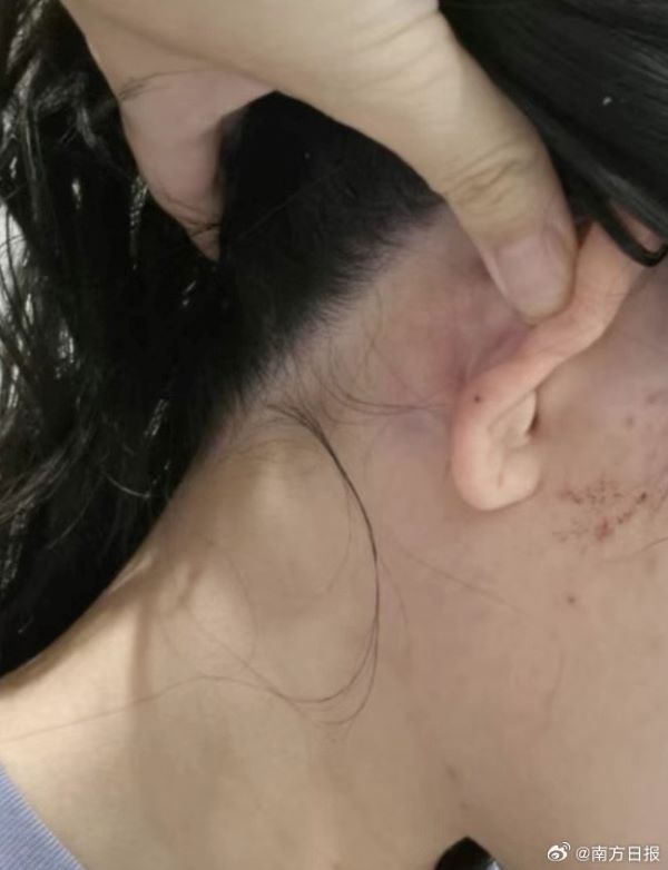   被圍毆的大陸女留學生，頭部、眼部、手部多處受傷，面部有嚴重抓傷。圖/取自南方日報微博