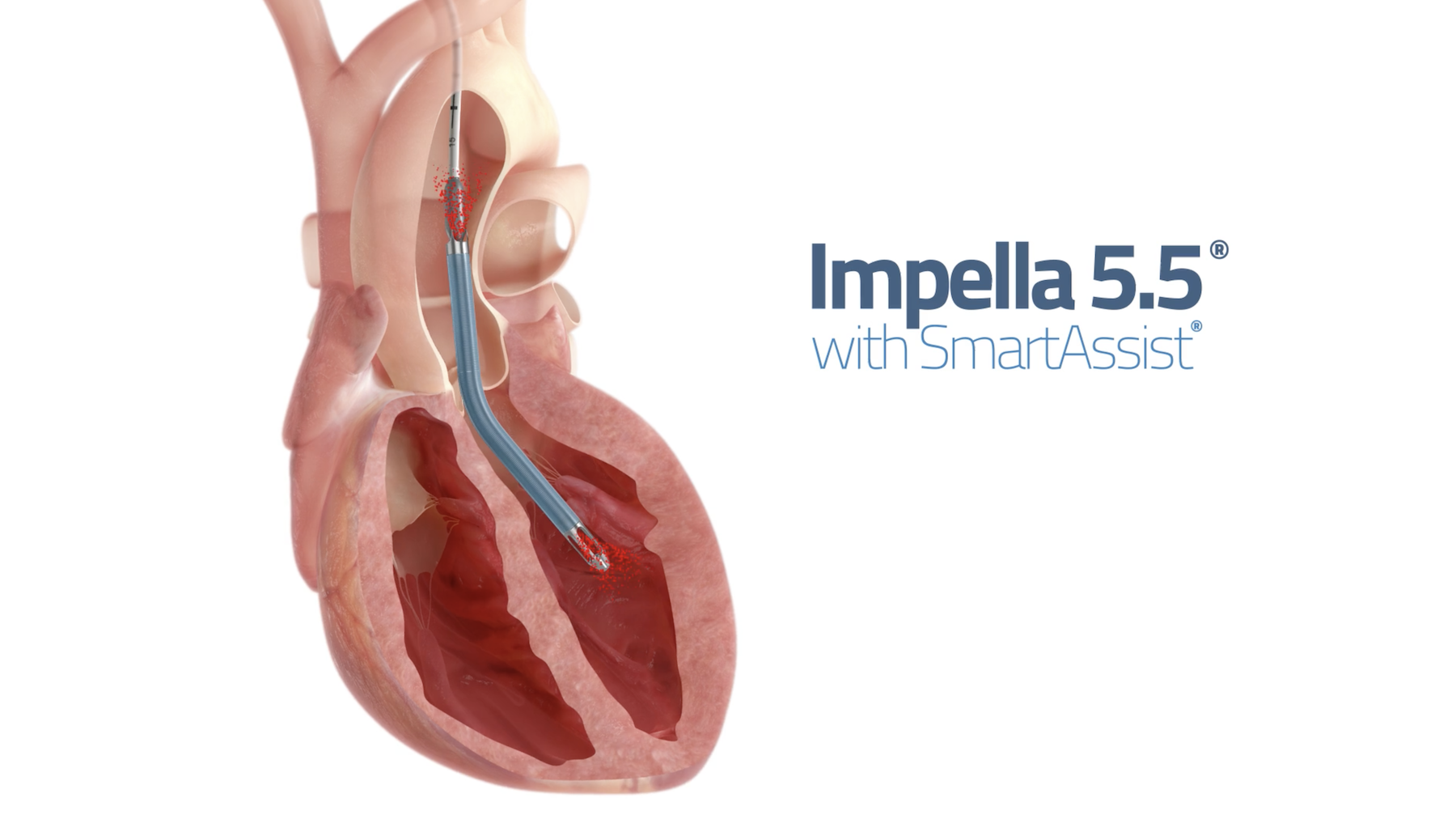 Imepella有多種型號的系列產品，其中Impella 5.5此次也在召回之列。圖/翻攝自Abiomed官網影片