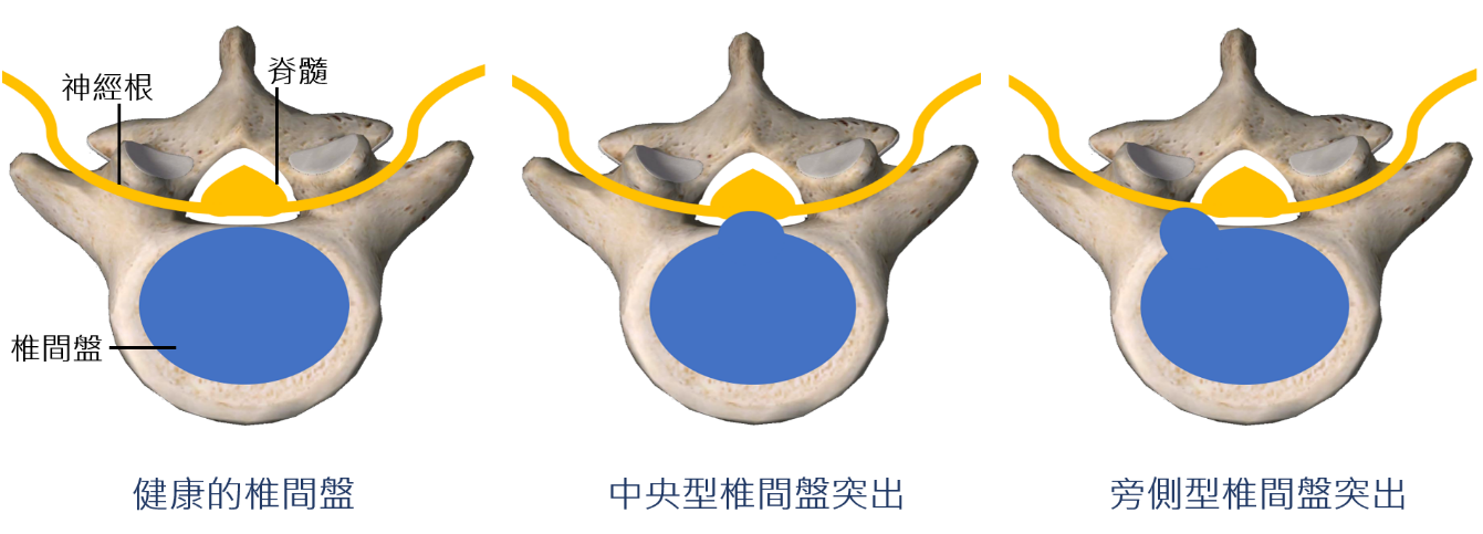 健康椎間盤及椎間盤突出之區別。圖/陳宇聖醫師提供